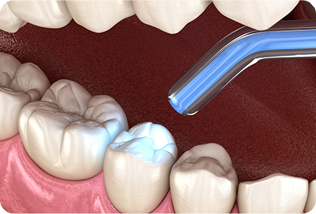 初期むし歯(C1)の治療