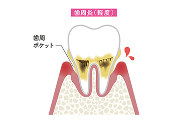 軽度歯周病
