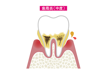中度歯周病