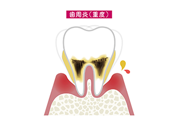 重度歯周病