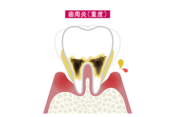 重度歯周病​